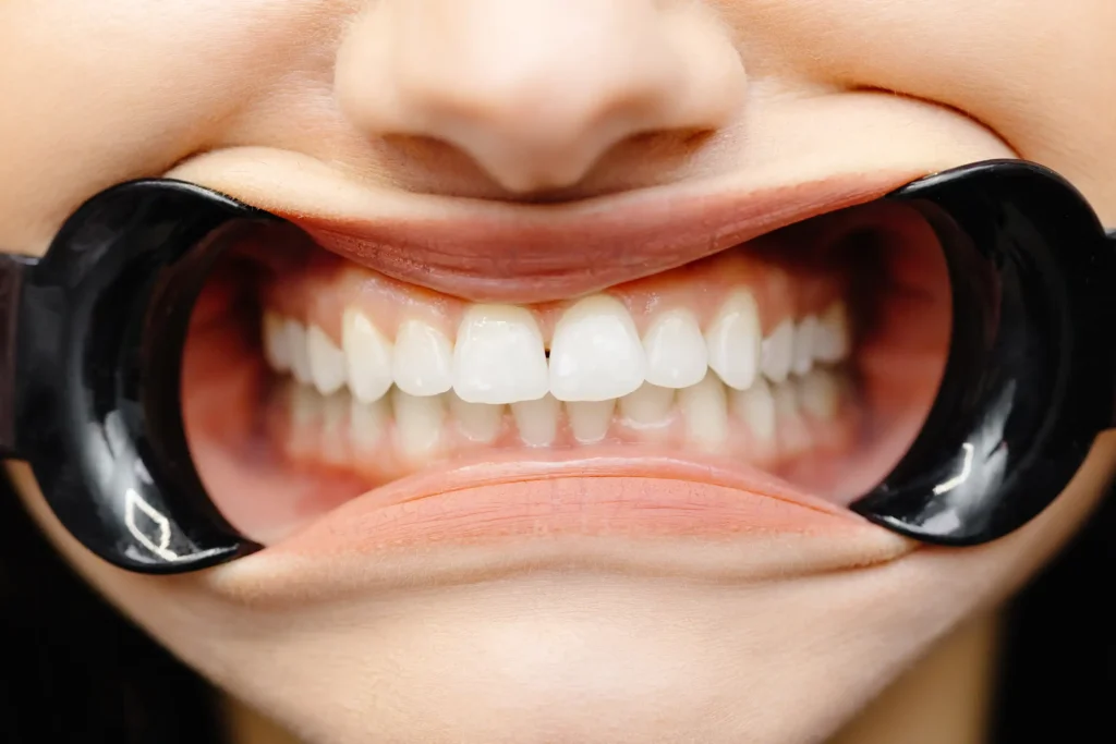 Zoom teeth whitening treatment for a brighter smile