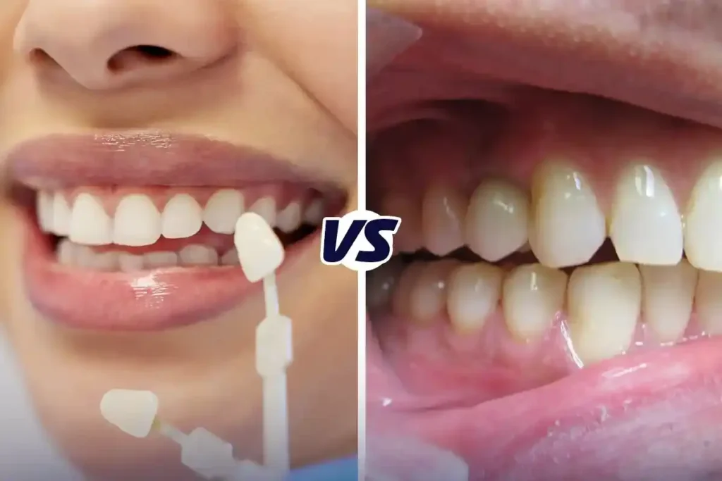 Dental Veneers vs Crowns
