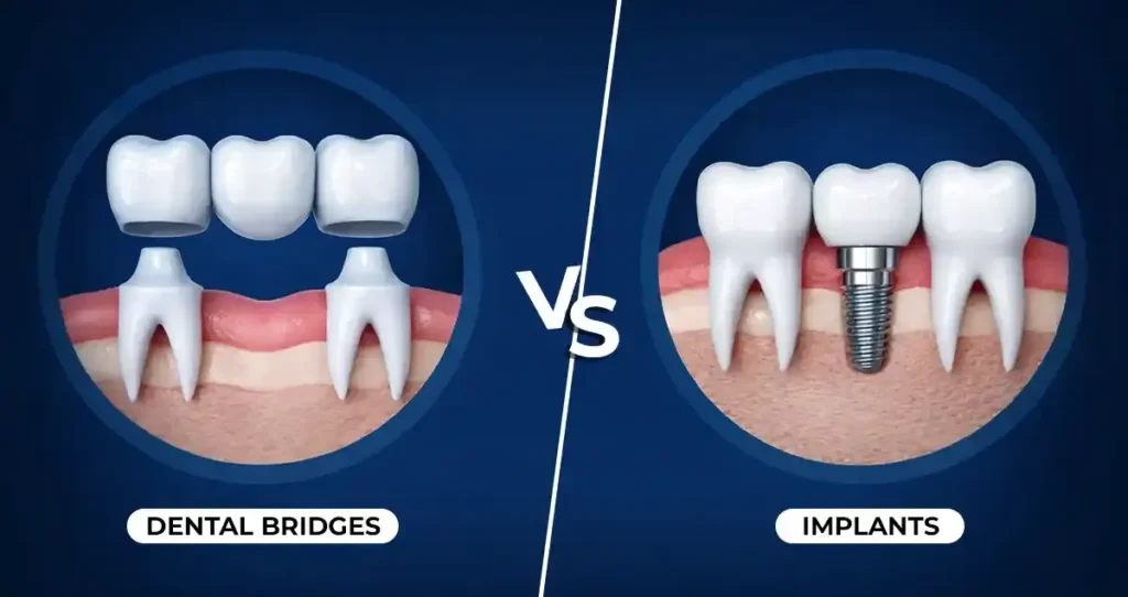 Dental Bridges vs Implants