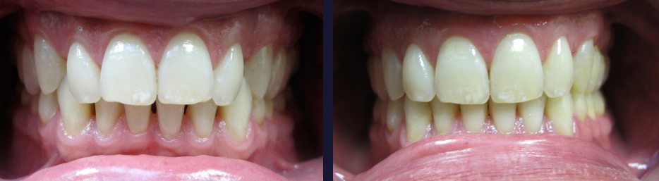 invisalign-result1.jpg