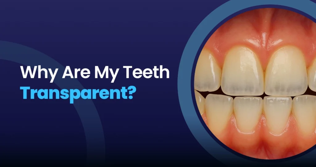 Close-up of transparent front teeth illustrating enamel erosion and tooth translucency