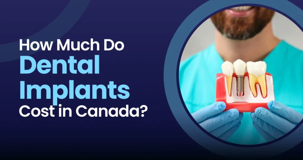 Dental implants cost in Canada