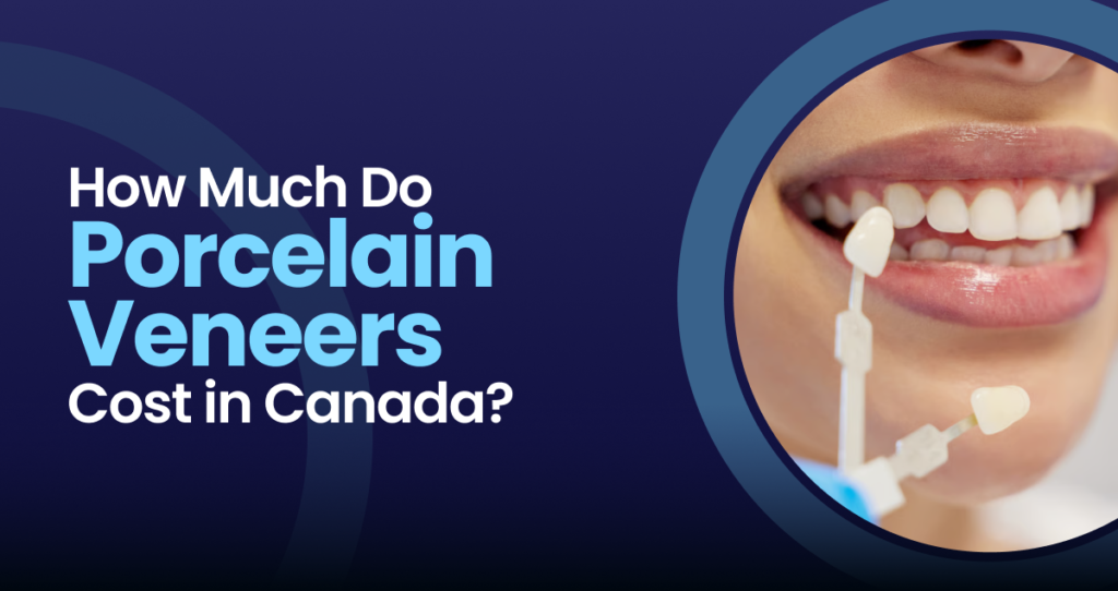 Porcelain Veneers Cost in Canada