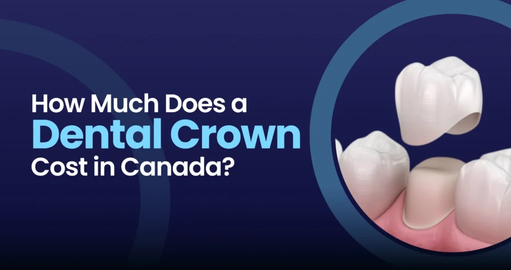 Dental crown cost in Canada guide