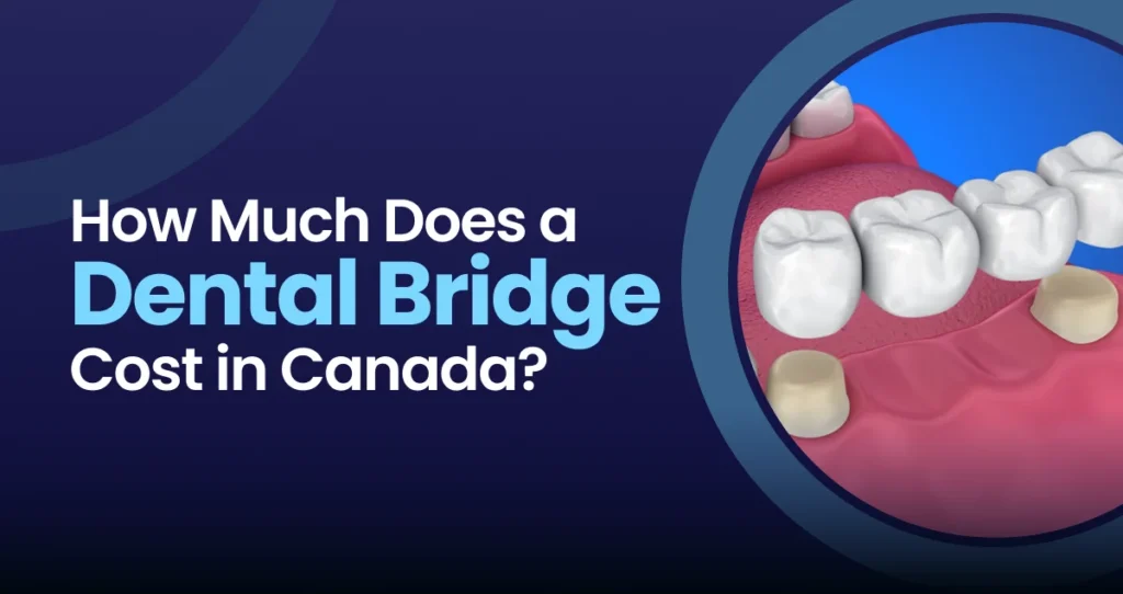 Dental Bridge Cost in Canada