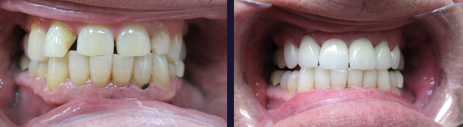 An actual teeth whitening case study at our Maple Ontario dental practice.