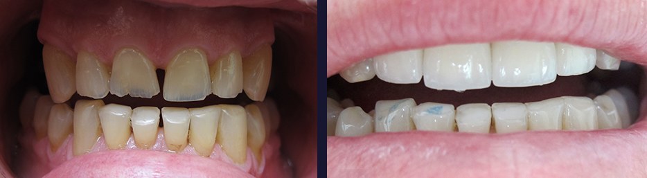 An actual patient of Dr. Gillmore in Maple, ON before and after treatment.