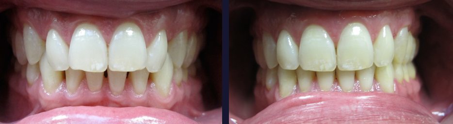 An actual patient of Dr. Gillmore in Maple, ON before and after treatment.